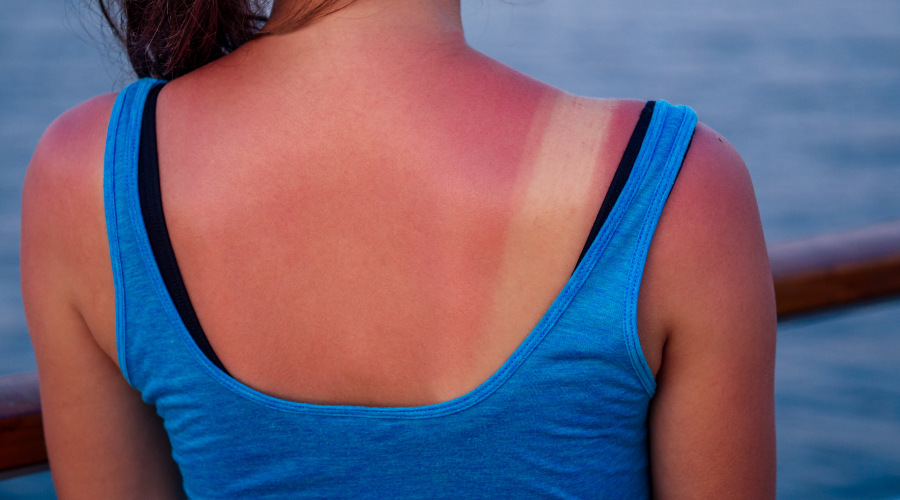 how to cure surnburn