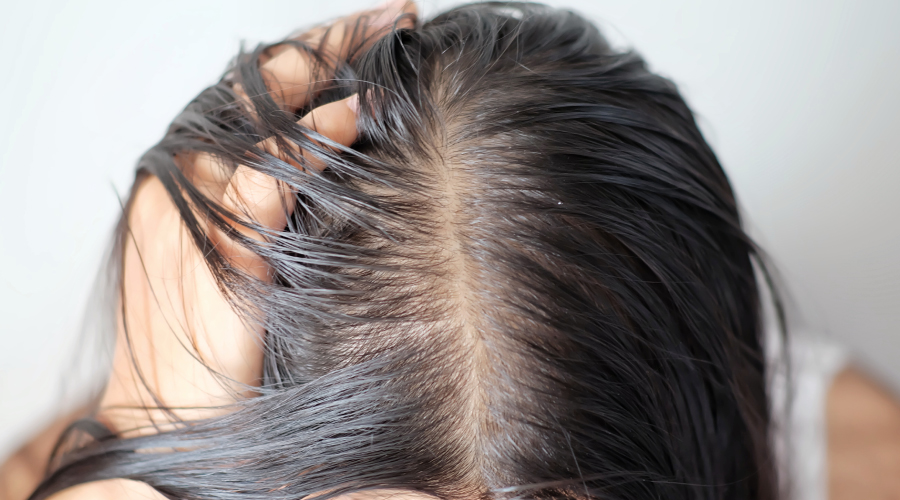oily scalp