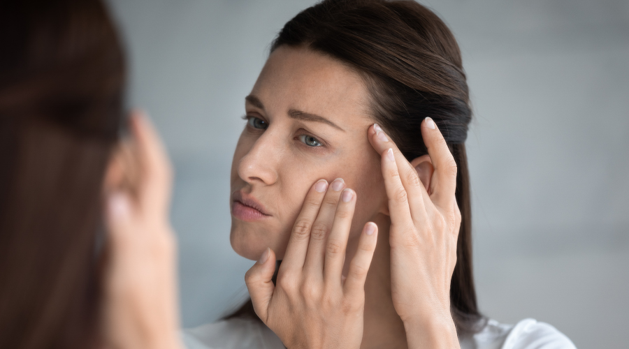 hyperpigmentation face