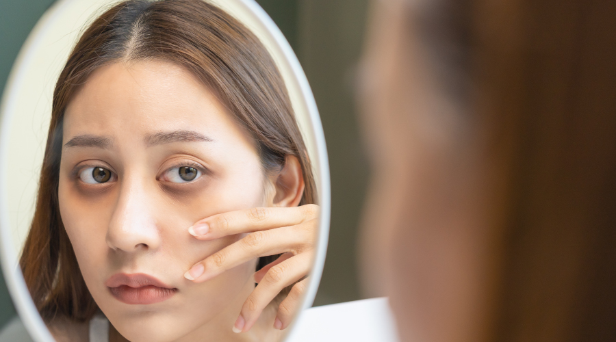 dark eye circles