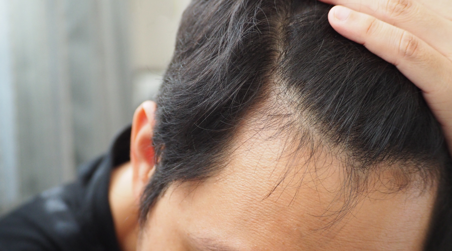 how to prevent hair loss